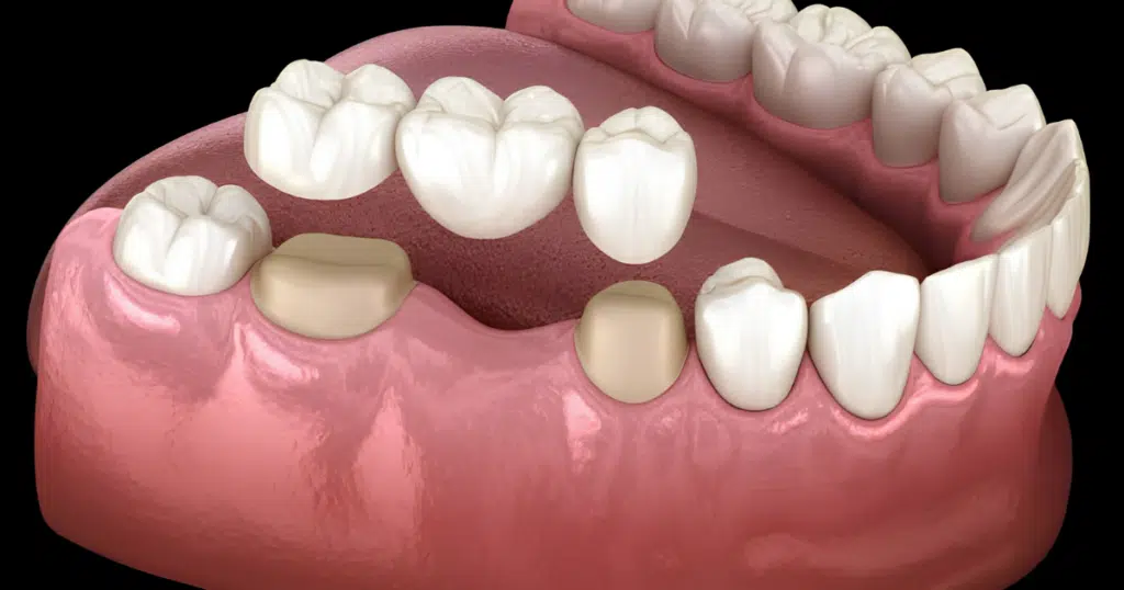 Dental Bridges - Fiocca Dental Arts - featured image