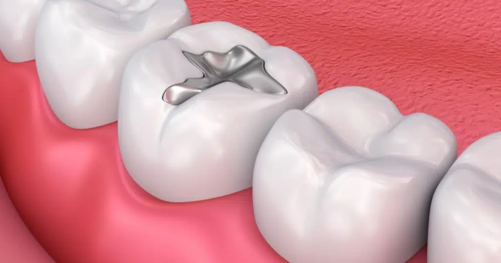 Dental Fillings- Fiocca Dental Arts- featured image