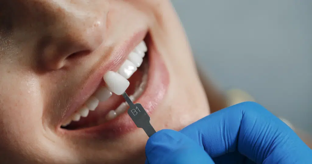 Dental Veneers - Fiocca Dental Arts - featured image
