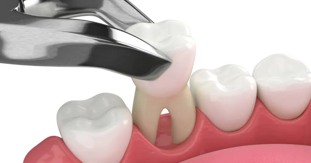 Extractions - Fiocca Dental Arts - featured image