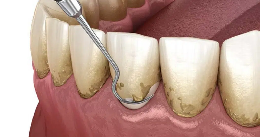 Periodontal care - Fiocca Dental Arts - featured image