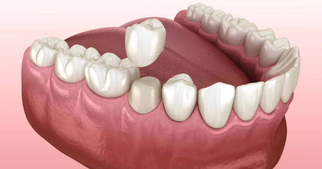 Restorative Dentistry - Fiocca Dental Arts - featured image
